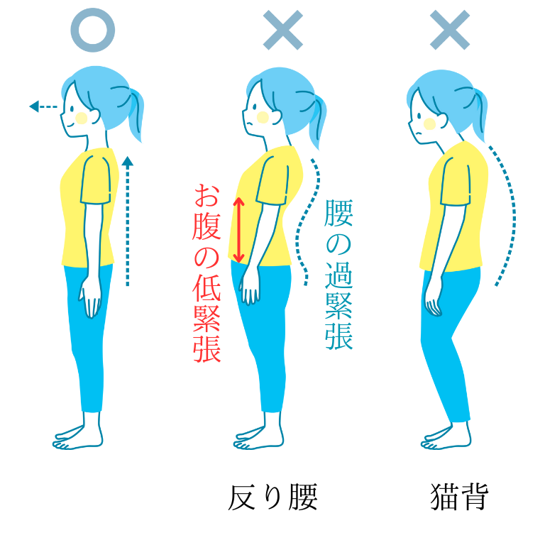 腰の過緊張による反り腰とその他姿勢パターン